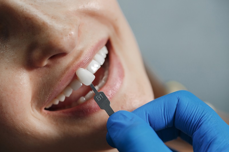 Are veneers harmful to your teeth in the long run?