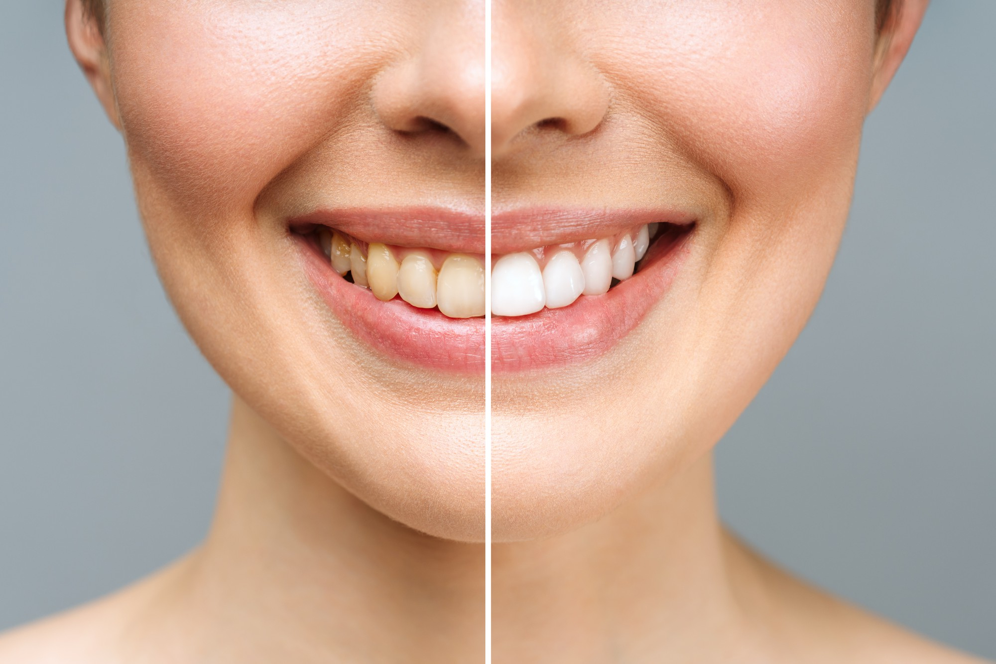 Ist es möglich, wieder weiße Zähne zu bekommen? in der Türkei