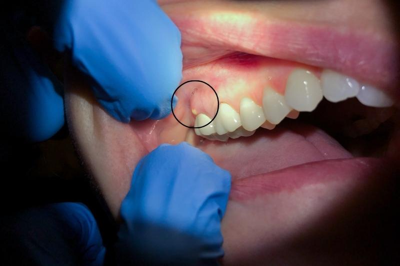 What are the Symptoms of Tooth Abscess What are the Symptoms of Tooth Abscess