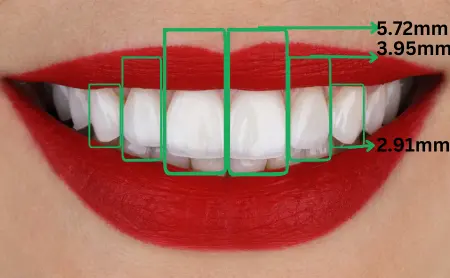 Tooth propotions in smile design