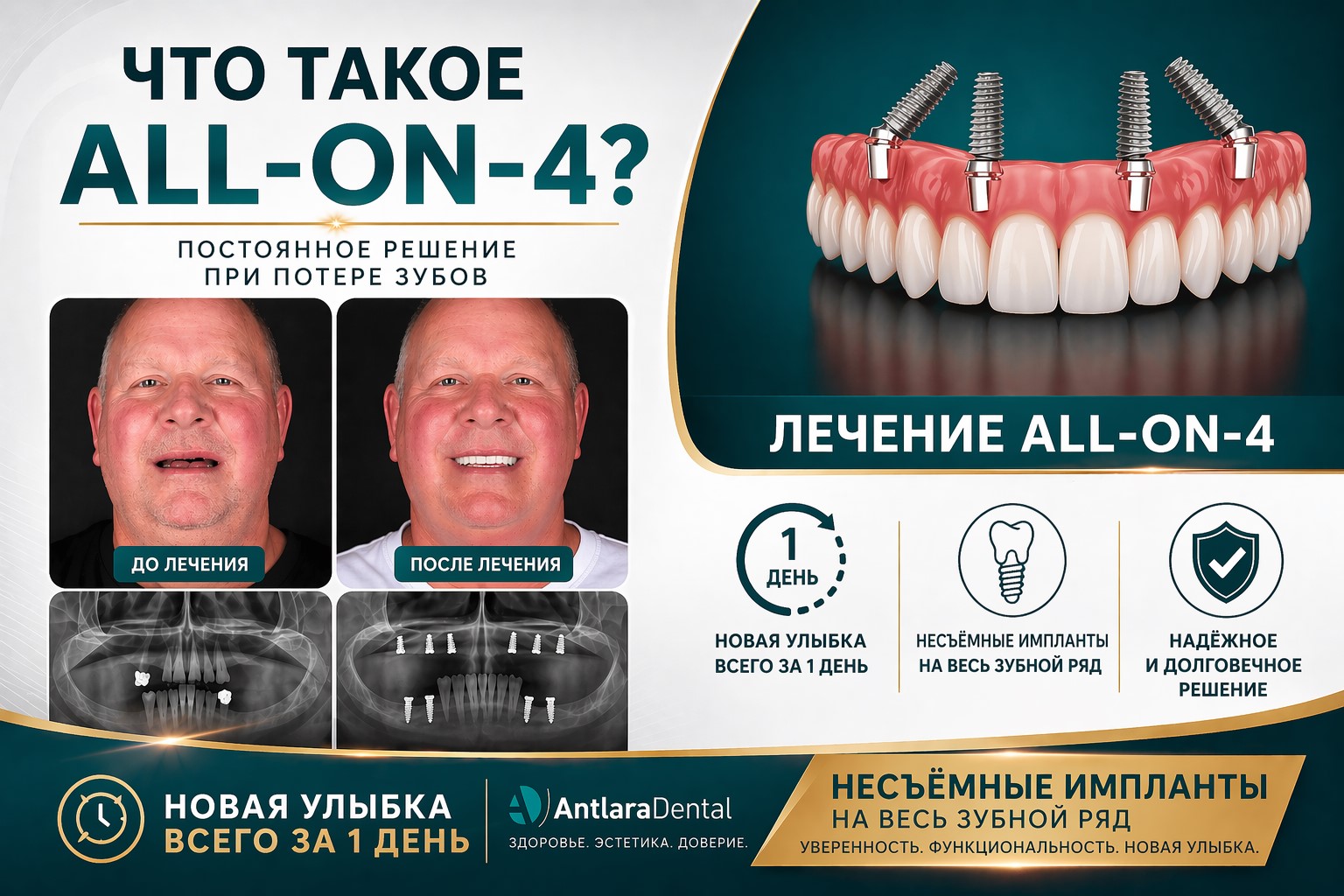 Что такое All-on-4?