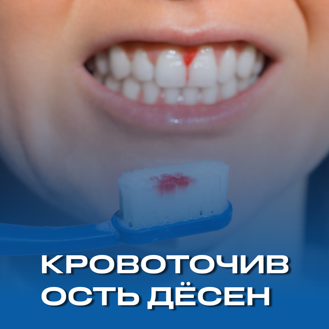Что вызывает кровоточивость десен и что следует делать?