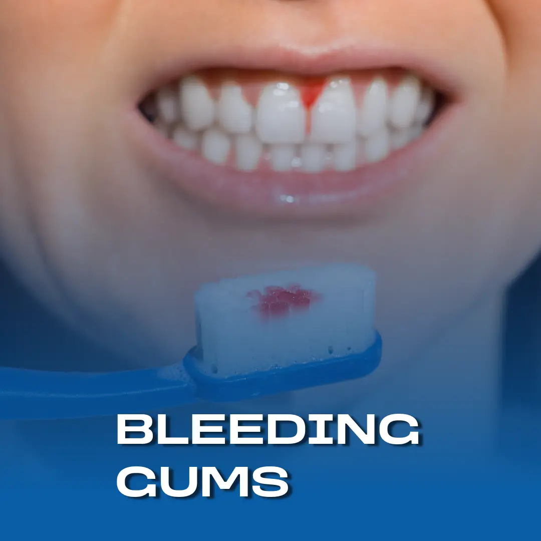 Why Are My Gums Bleeding?