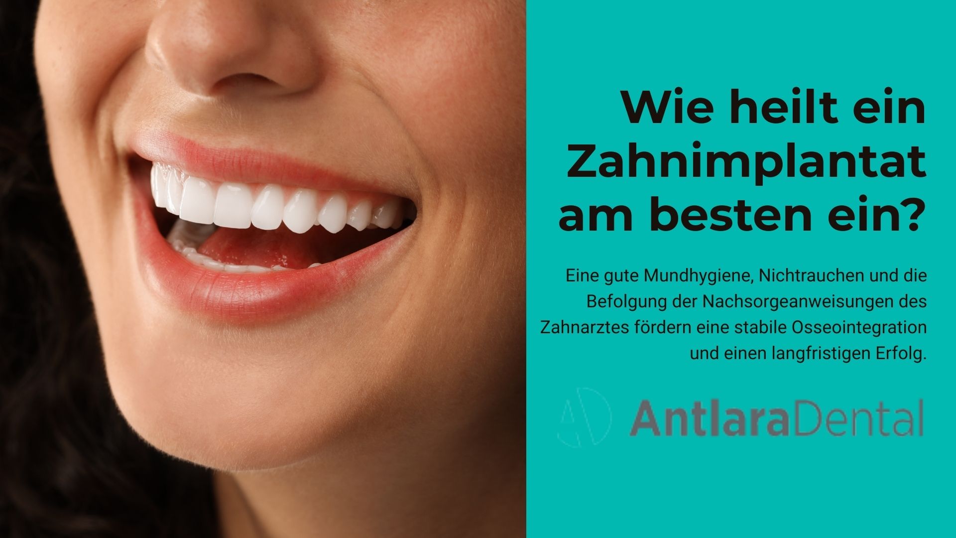 Wie heilt ein Zahnimplantat am besten ein? 