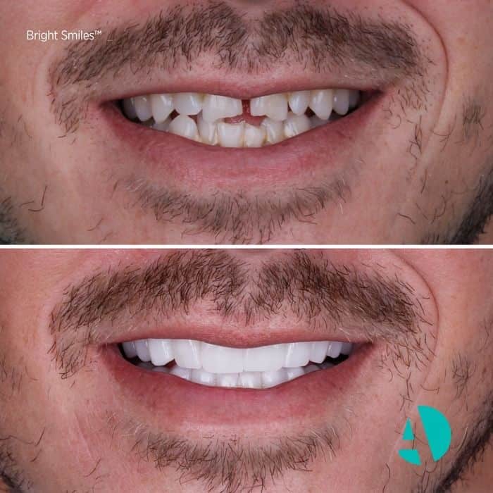 Zirconia Crown Before & After Photo Zirconia Crown Turkey before after photo