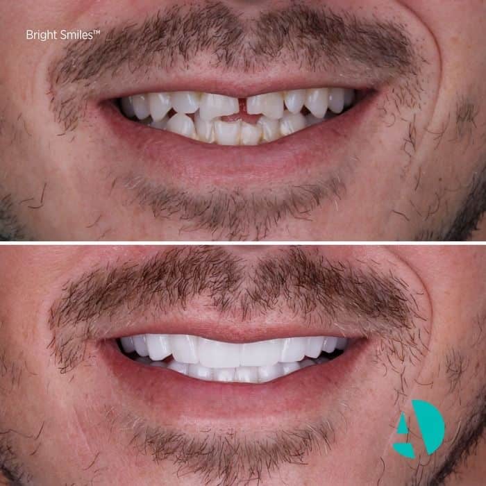 Zirconia Crown Turkey before after photo