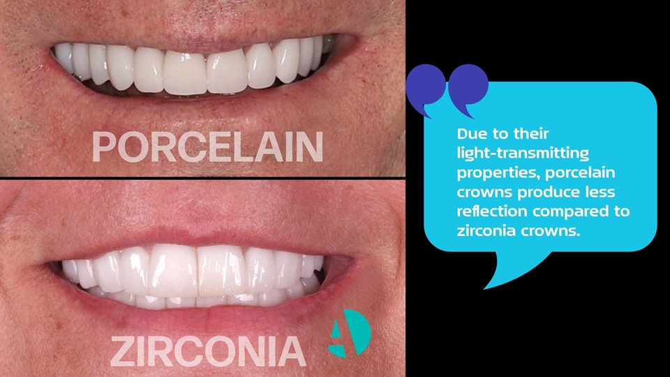Zirconium Crowns and Porcelain Crowns Zirconium Crowns and Porcelain Crowns