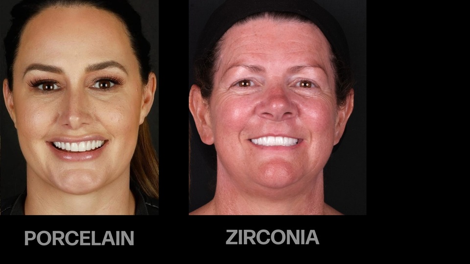 Zirconium Crowns and Porcelain Crowns: Which Is Better? Zirconium Crowns and Porcelain Crowns: Which Is Better?