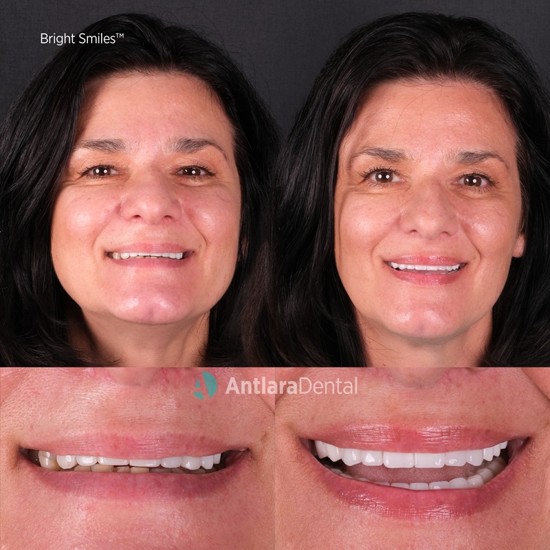 Advantages of Zirconium Crowns Advantages of Zirconium Crowns