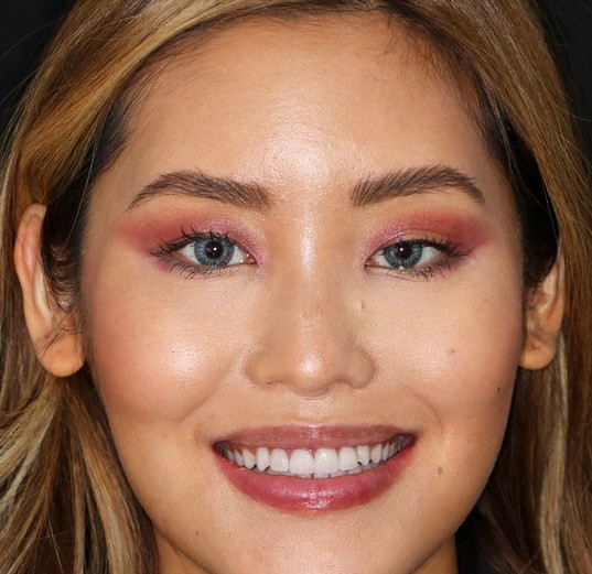 Advantages of Porcelain Crowns Advantages of Porcelain Crowns