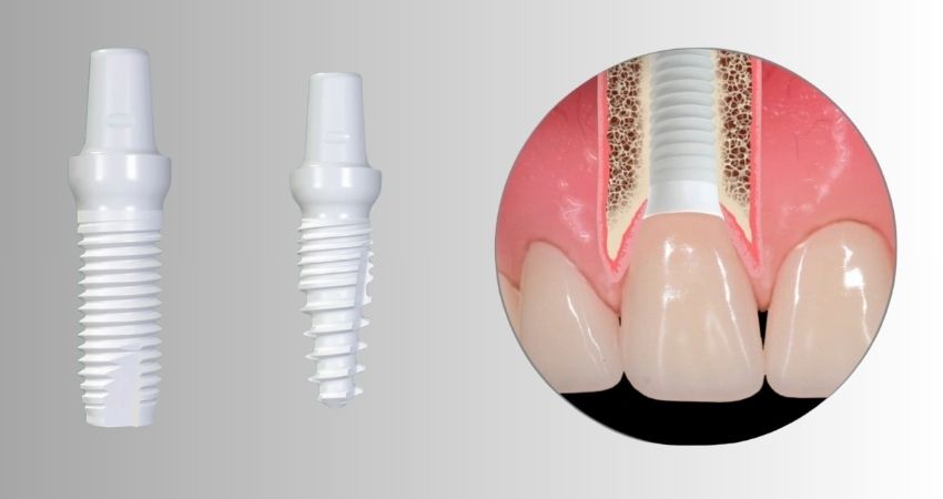 Zirkonyum İmplant - Seramik İmplant Nedir? - Antalya Zirkonyum İmplant - Seramik İmplant Nedir? Antalya