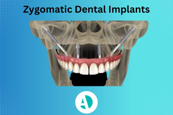 Zygomatic implant Antalya