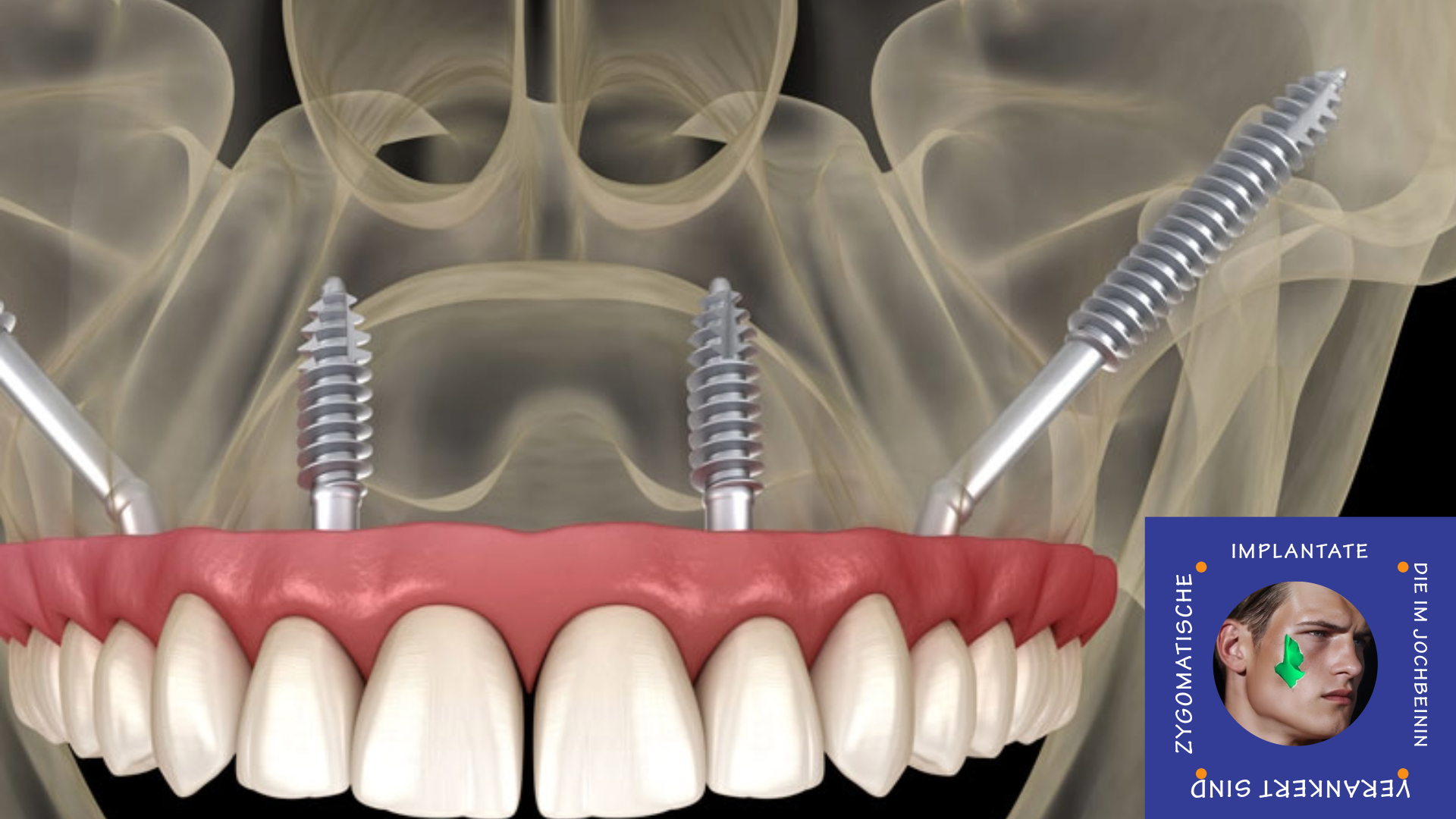 Jochbeinimplantate | Implantate ohne Knochentransplantation Jochbeinimplantate | Implantate ohne Knochentransplantation