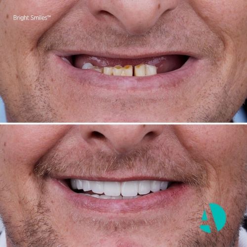 vor und nach dem All-on-4-Zahnimplantat