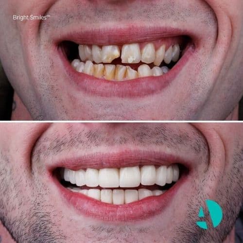 Zirkonyum Diş Kaplama Tedavisi Öncesi Sonrası Antalya