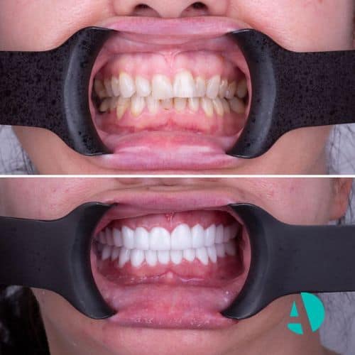 vor und nach dem Zahnaufhellung in der Turkei