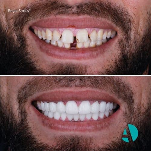 vor und nach dem ästhetische Zahnmedizin in Antalya