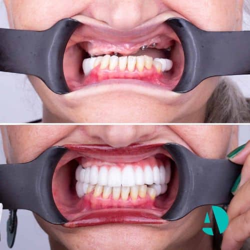 All on Four Diş Tedavisi Öncesi Sonrası, fiyatları Antalya