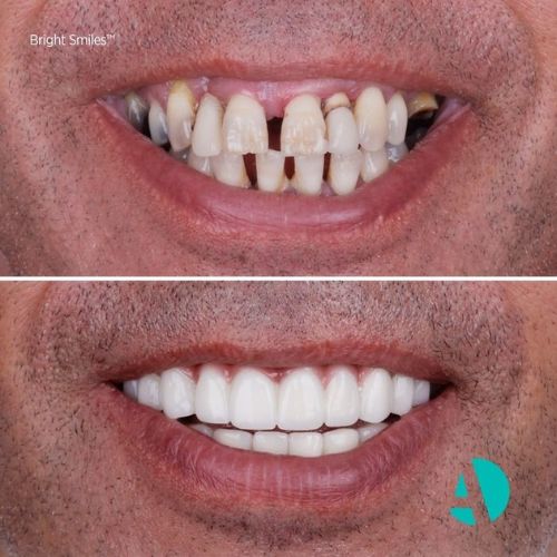 vor und nach dem All-on-4-Zahnimplantat Antalya