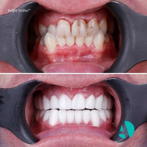 Ortodonti Tedavisi Öncesi Sonrası, fiyatları Antalya