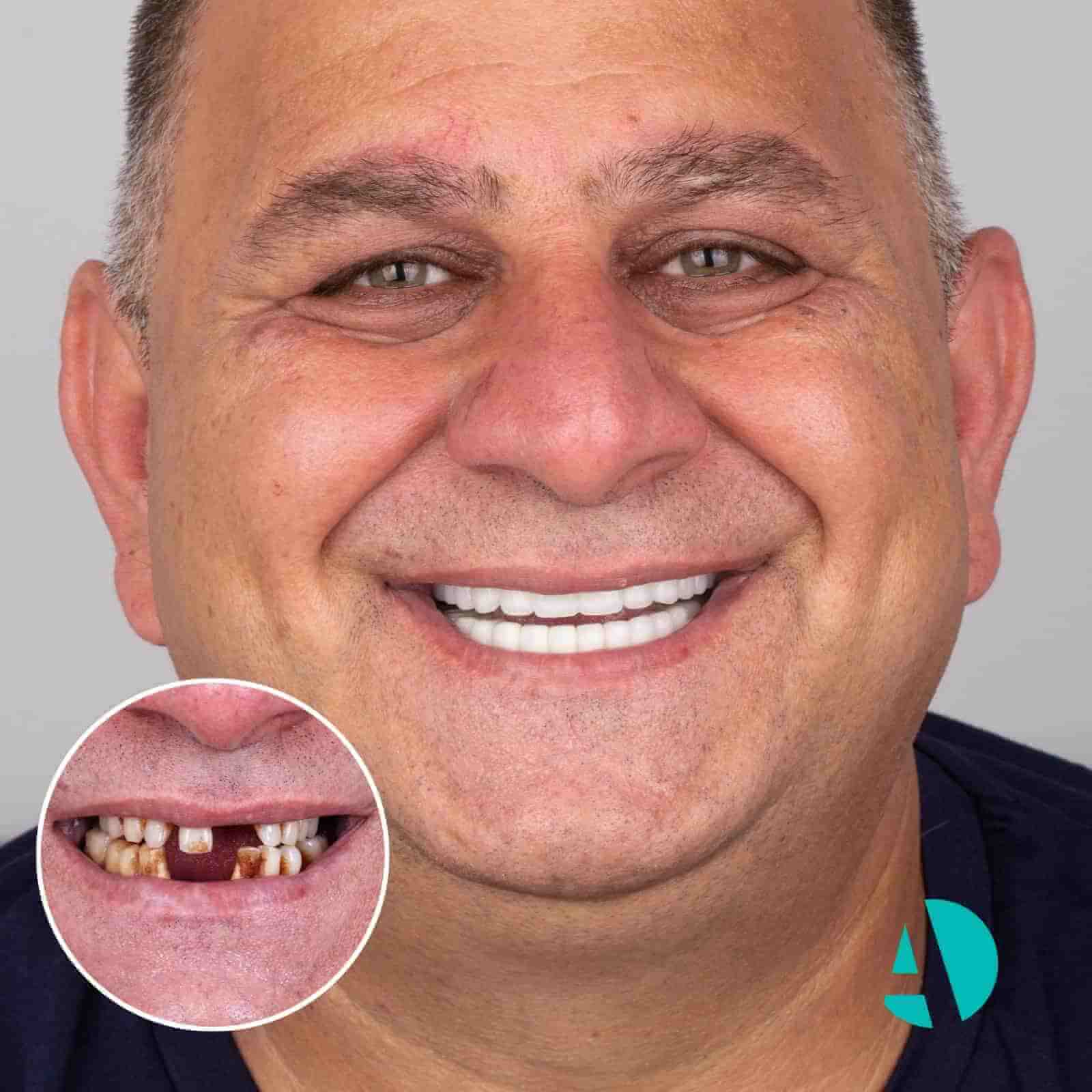 до и после установки зубных имплантатов