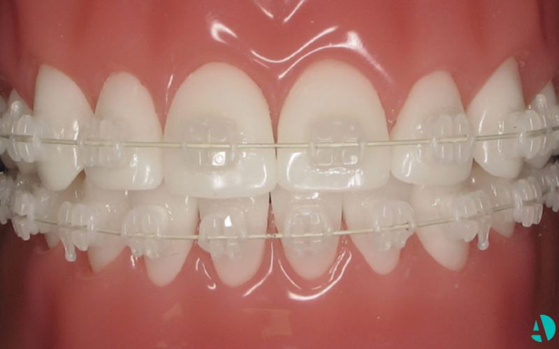 A teeth model with ceramic braces on it.