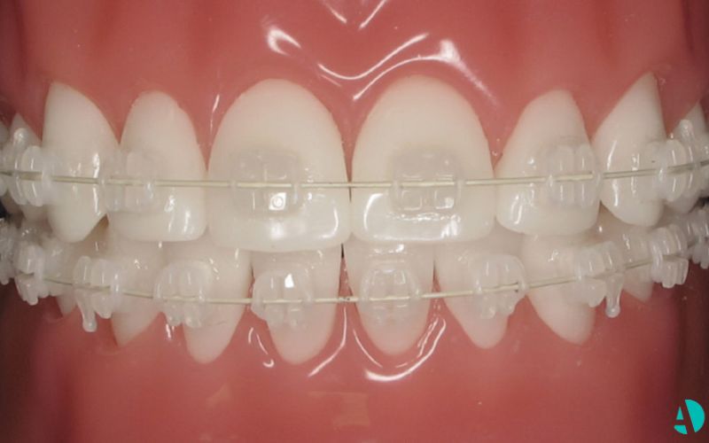 A teeth model with ceramic braces on it A teeth model with ceramic braces on it.