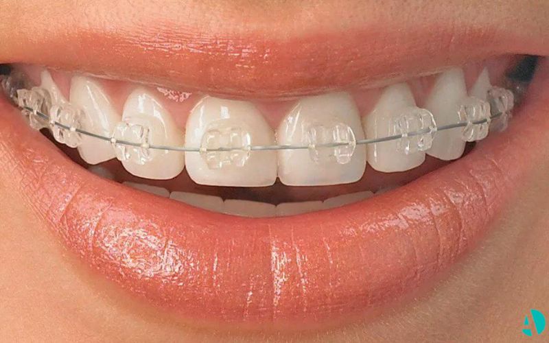 women smiles with a pretty Ceramic Braces on her teeth