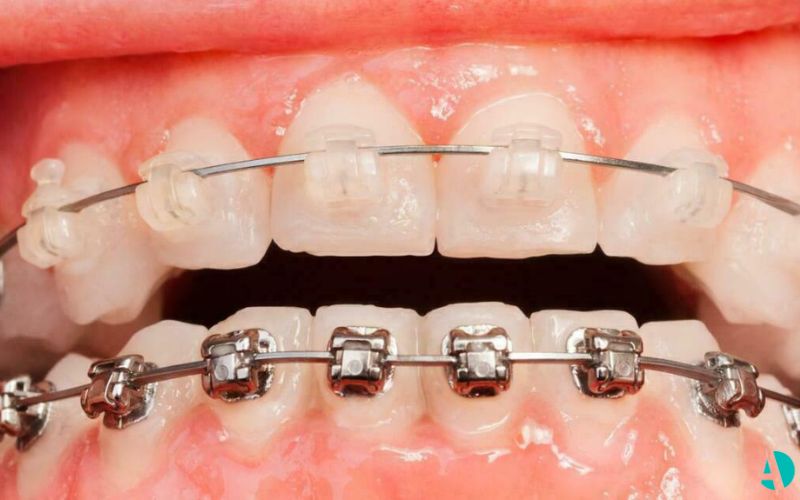 Ceramic braces vs clasic braces patient teeth upper teeth with metal braces and lower teth with ceramic braces