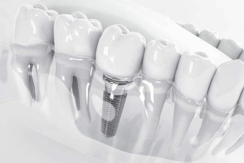 модель прозрачных зубов с имплантатом зуба внутри