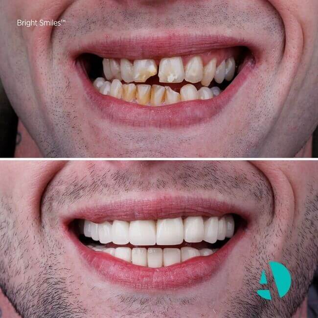 dental veneers before after image