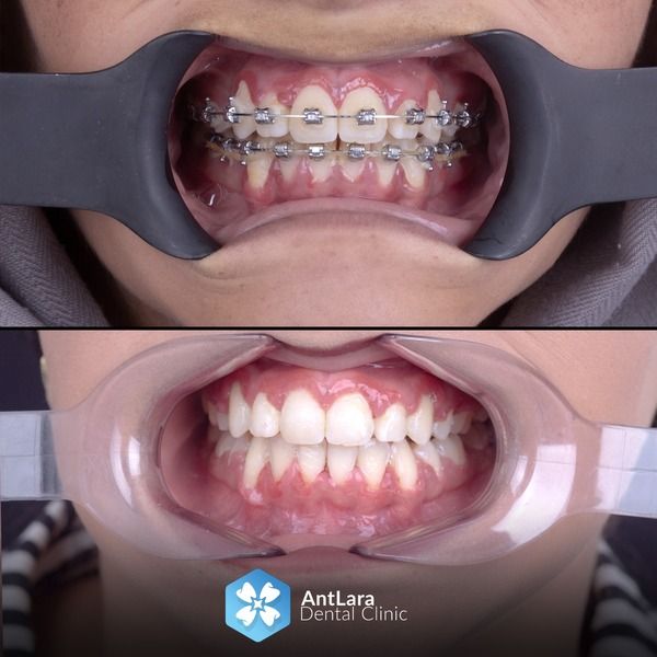 Ortodonti-Diş Tedavisi nedir? ortodontist Antalya