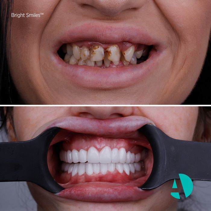 E-max Veneers
E-Max Veneers cost antalya turkey
