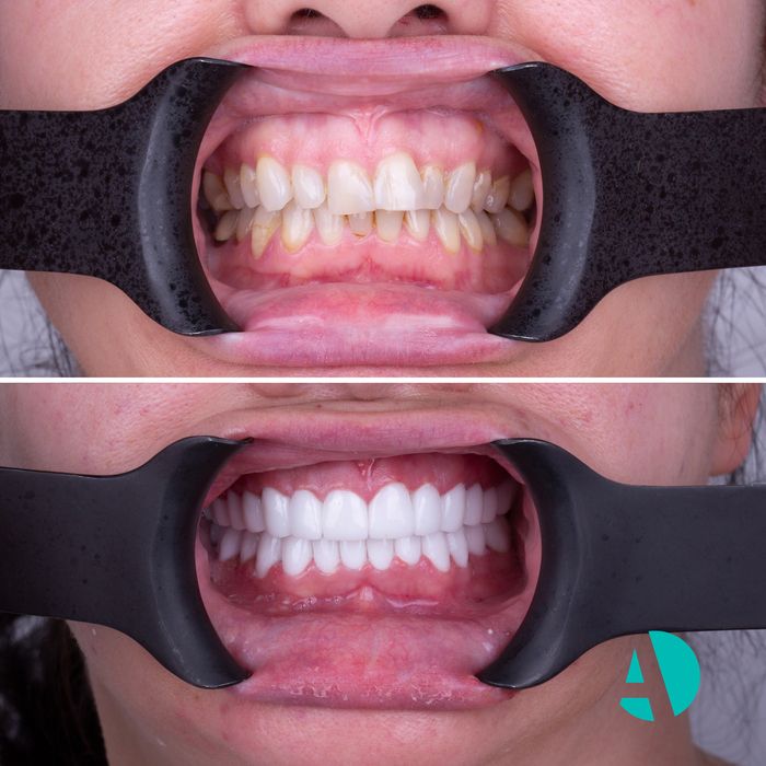 E-max Veneers Before After emax veneers before after image