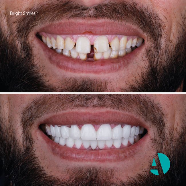 emax veneers before after