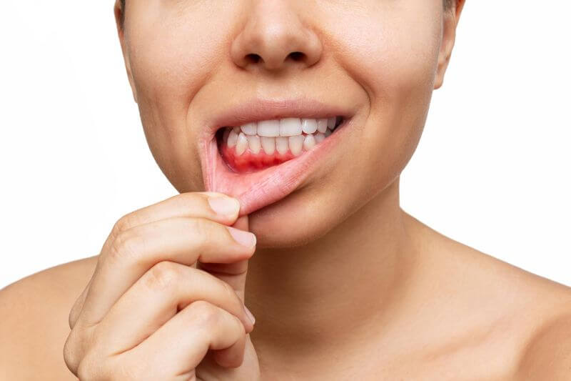 Gum Disease women shows her teeth suffer from Gum Disease