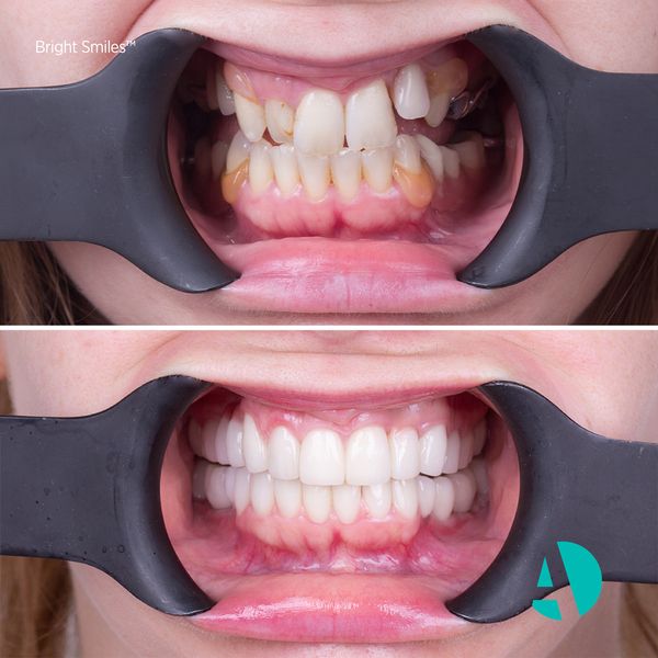 dental braces before after image