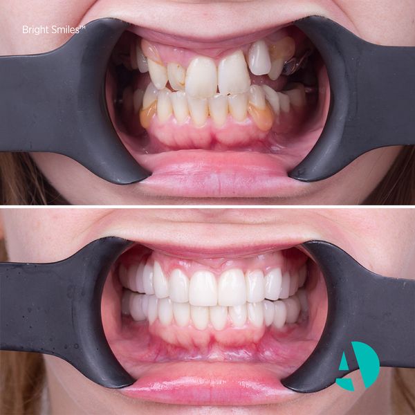 Metal Braces Before & After dental braces before after image Antalya Turkey