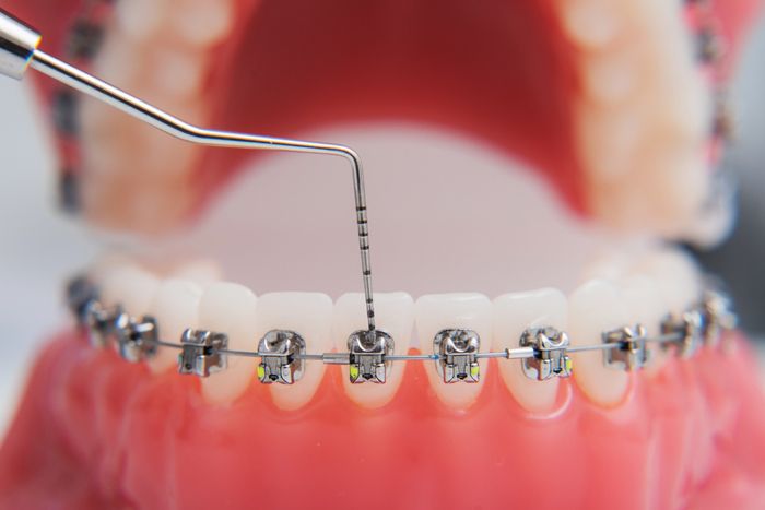 Metal Braces metal braces are aligning on the teeth model