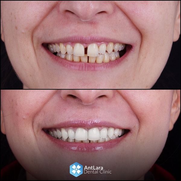 women dental braces before after image 
