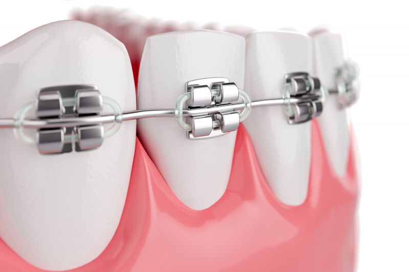 dental braces are on the mini teeth model 