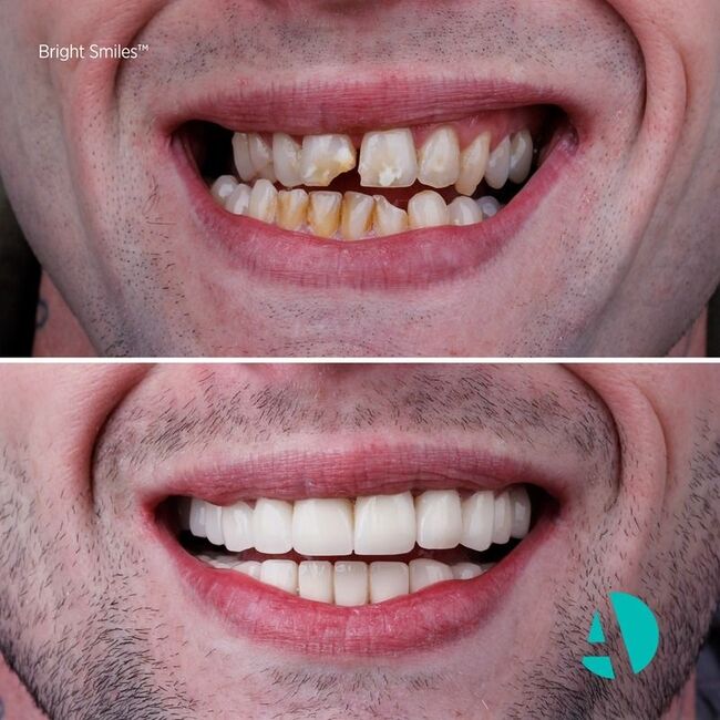 Porcelain Crowns (PFM Crowns) before after