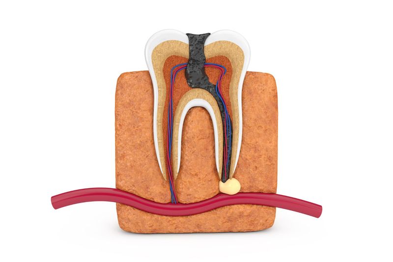 Root Canal Treatment the situation of a teeth needs Root Canal Treatment is shown on a mini teeth model.