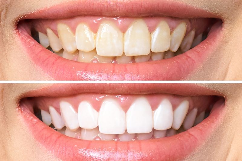 Teeth Whitening before after image