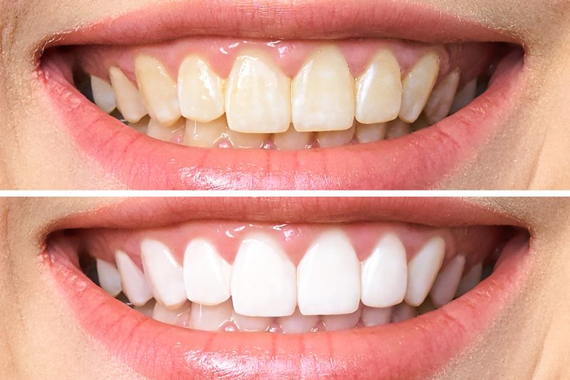 Teeth Whitening before after antalya turkey