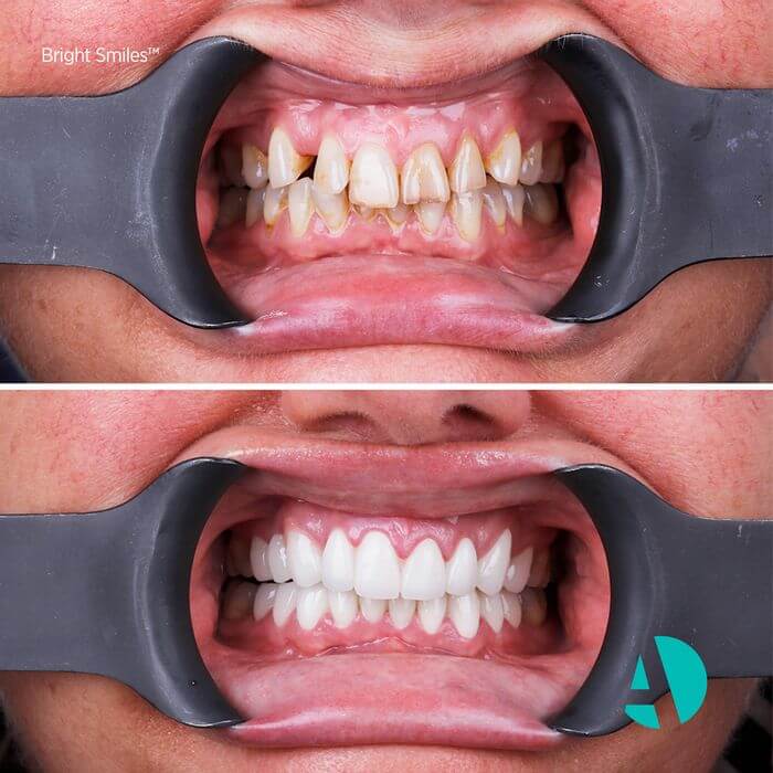 Zirconia Crown Before After Photo Zirconia Crowns before after
